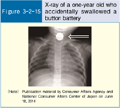 Figure 3-2-15 X-ray of a one-year old who accidentally swallowed a button battery